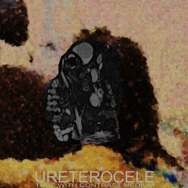 Фото: Ureterocele